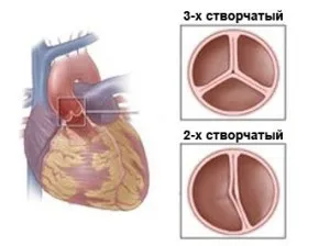 ВПС двухстулковий аортальний клапан (клапан) ВПС двухстулковий аортальний клапан