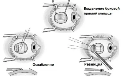 Вроджена косоокість види захворювання, як лікувати (лікувати) Вроджена косоокість види захворювання, як лікувати