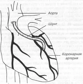Хірургічні способи лікування ІХС (способи) Хірургічні способи лікування ІХС