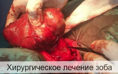 Хірургічне лікування зоба 1 (хірургічному лікуванні зоба) Хірургічне лікування зоба 1