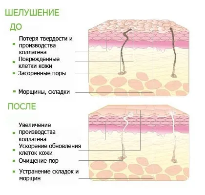 Хімічні пілінги, види хімічних пілінгів