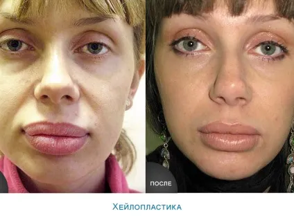 Хейлопластика що це за операція, показання для проведення пластики губ, достоїнства і недоліки