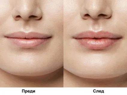 Хейлопластика що це за операція, показання для проведення пластики губ, достоїнства і недоліки