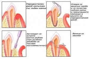 Хронічний пародонтит причини, ознаки і лікування (кореневої частини зуба) Хронічний пародонтит причини, ознаки і лікування