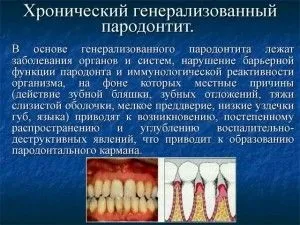 Хронічний пародонтит причини, ознаки і лікування (кореневої частини зуба) Хронічний пародонтит причини, ознаки і лікування
