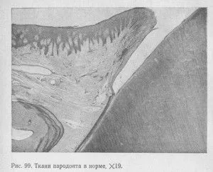 Хронічний пародонтит причини, ознаки і лікування (кореневої частини зуба) Хронічний пародонтит причини, ознаки і лікування