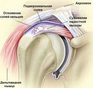 Хрускіт в плечовому суглобі причини, лікування, профілактика (хрускіт плечовому суглобі причини) Хрускіт в плечовому суглобі причини, лікування, профілактика