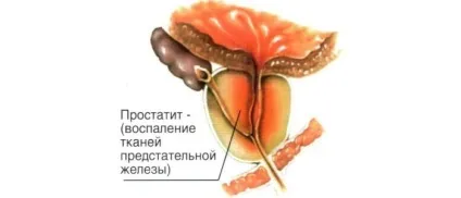 Хронічний простатит абактеріальний - особливості та лікування (хронічний простатит абактеріальний) Хронічний простатит абактеріальний - особливості та лікування