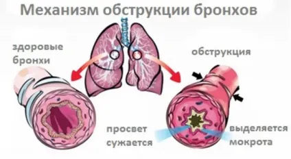 Хронічний бронхіт у дітей лікування, симптоми, причини, профілактика, фото, відео