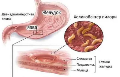 Хронічний поверхневий гастрит симптоми, лікування ліками і народними засобами, дієта
