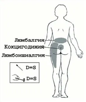 Моторошно болить поперек і віддає в ногу, ніж лікувати