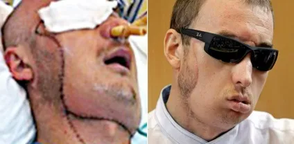 10 Самих неймовірних операцій з пересадки обличчя в історії (особи) 10 Самих неймовірних операцій з пересадки обличчя в історії