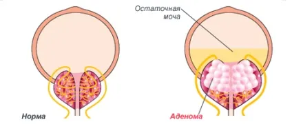 Аденома простати у чоловіків симптоми, лікування народними засобами, травами (простати) Аденома простати у чоловіків симптоми, лікування народними засобами, травами