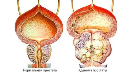 Аденома простати симптоми і лікування, перші ознаки захворювання (передміхурова залоза доброякісна гіперплазія аденома простати захворювання симптоми ознаки лікування) Аденома простати симптоми і лікування, перші ознаки захворювання