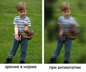 Ангіопатія сітківки одного або обох очей що це таке (ангіопатія) Ангіопатія сітківки одного або обох очей що це таке