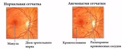 Ангіопатія сітківки одного або обох очей що це таке (ангіопатія) Ангіопатія сітківки одного або обох очей що це таке
