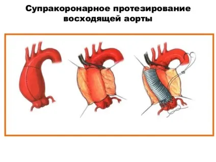 Аневризми синусів Вальсальви лікування, операція, таблетки, пластика (Вальсальви) Аневризми синусів Вальсальви лікування, операція, таблетки, пластика