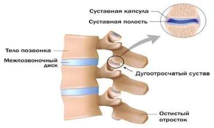 Артроз міжхребцевих суглобів причини і лікування (лікування) Артроз міжхребцевих суглобів причини і лікування