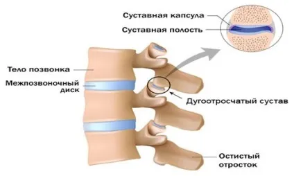 Артроз міжхребцевих суглобів (міжхребцевих) Артроз міжхребцевих суглобів