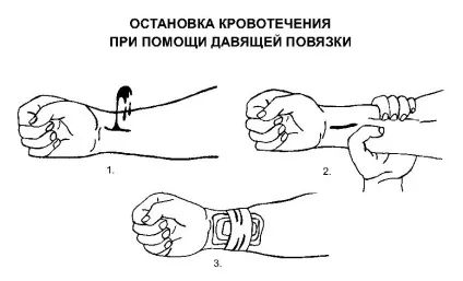 Артеріальна кровотеча - перша допомога, що робити (перша) Артеріальна кровотеча - перша допомога, що робити