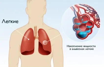 Банки при кашлі чи можна ставити і як ними правильно лікуватися (банки) Банки при кашлі чи можна ставити і як ними правильно лікуватися