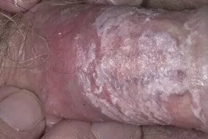 Чи буває молочниця у чоловіків - від куди береться, симптоми, лікування (молочниця) Чи буває молочниця у чоловіків - від куди береться, симптоми, лікування