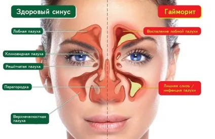 Біопарокс при гаймориті інструкція, відгуки