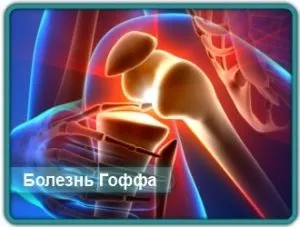 Хвороба Гоффа або ліпоартріт вся інформація про захворювання (хвороба Гоффа симптоми) Хвороба Гоффа або ліпоартріт вся інформація про захворювання