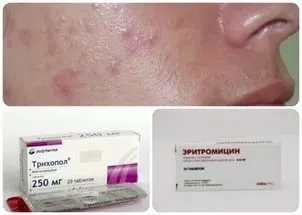 Болючі прищі на обличчі причина