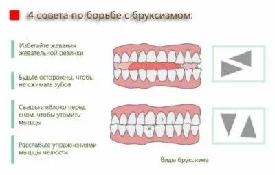 Бруксизм у дітей причини, симптоми і його лікування (симптоми) Бруксизм у дітей причини, симптоми і його лікування