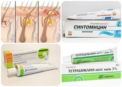 Болючі прищі на обличчі причина