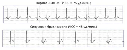 Брадикардія у дітей - класифікація, причини, лікування (дітей) Брадикардія у дітей - класифікація, причини, лікування