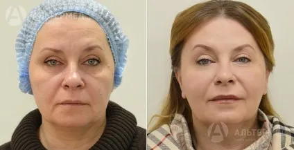 Botox (ботокс) в Харкові