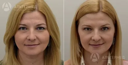 Botox (ботокс) в Харкові