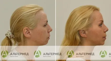 Botox (ботокс) в Харкові