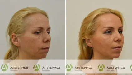 Botox (ботокс) в Харкові