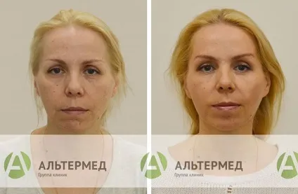 Botox (ботокс) в Харкові