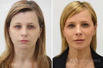 Botox (ботокс) в Харкові