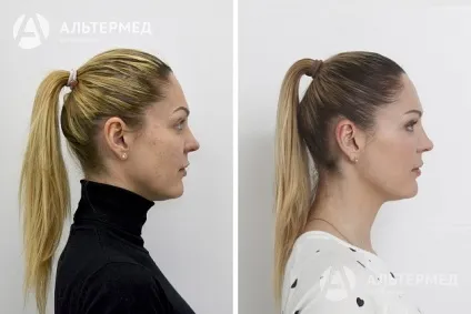 Botox (ботокс) в Харкові