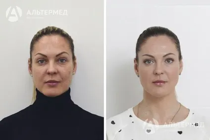 Botox (ботокс) в Харкові