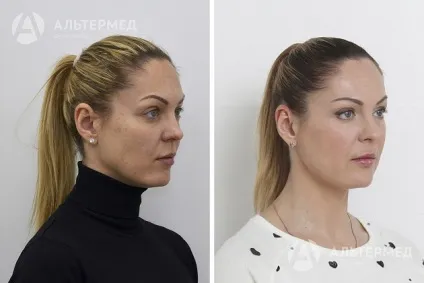 Botox (ботокс) в Харкові