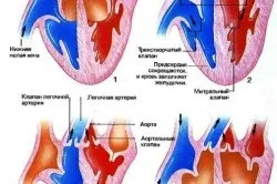 Чим небезпечна миготлива аритмія серця 1 (серця) Чим небезпечна миготлива аритмія серця 1