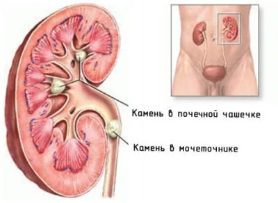 Чим небезпечні камені в нирках наслідки у чоловіків і жінок (нирках) Чим небезпечні камені в нирках наслідки у чоловіків і жінок