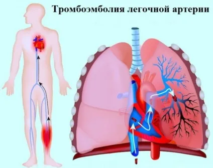Чим небезпечний тромбофлебіт нижніх кінцівок (небезпечний тромбофлебіт нижніх) Чим небезпечний тромбофлебіт нижніх кінцівок