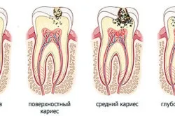 Чорні плями на зубах як позбутися (чорні) Чорні плями на зубах як позбутися