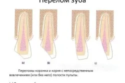 Що робити, якщо відколовся шматочок зуба (відколовся) Що робити, якщо відколовся шматочок зуба