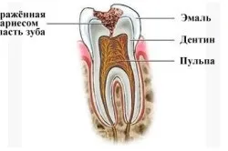 Що робити, якщо відколовся шматочок зуба (робити) Що робити, якщо відколовся шматочок зуба