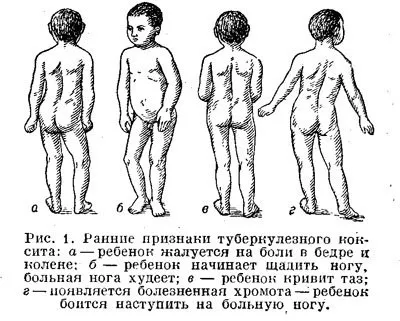 Туберкульоз кісток причини, форми, симптоми, лікування