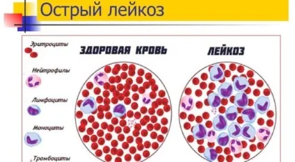 Тромбоцитопенія причини і лікування у дорослих (причини) Тромбоцитопенія причини і лікування у дорослих