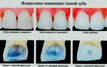 Тріщини на зубній емалі фото, причини появи і лікування в стоматології (зубний) Тріщини на зубній емалі фото, причини появи і лікування в стоматології